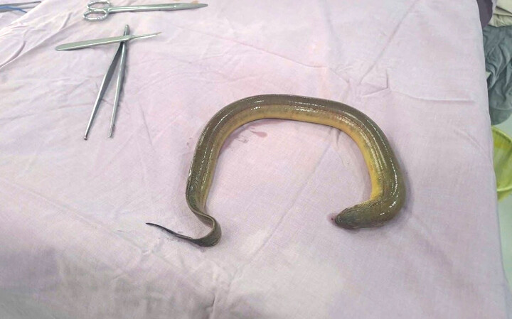 Con lươn dài khoảng 50cm trong ổ bụng bệnh nhân. (Ảnh: L.N)