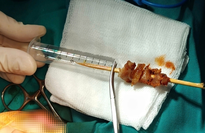 Sau khi rút toàn bộ que tre, tình trạng huyết động của bệnh nhi vẫn ổn định. (Ảnh: BVCC)