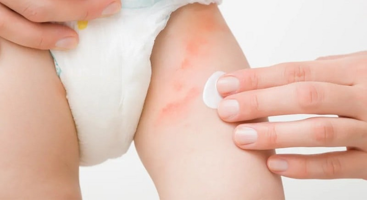 Chọn sai kích cỡ khiến bỉm bị chật, bó sát da gây vết hằn đỏ trên da bé.