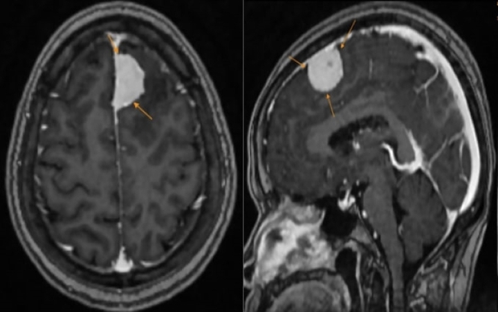Hình ảnh khối u được phát hiện trên phim chụp MRI.