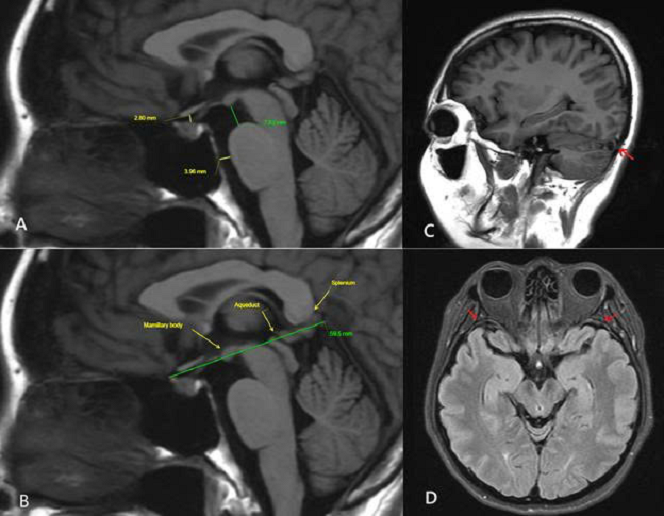 MRI sọ não lần 3 ghi nhận nhiều dấu hiệu gợi ý hội chứng giảm áp lực nội sọ do rò dịch não tủy, bao gồm: não sa thấp nhẹ, các khoang dịch quanh não thu hẹp, giãn các xoang tĩnh mạch nội sọ và dày nhẹ màng não.