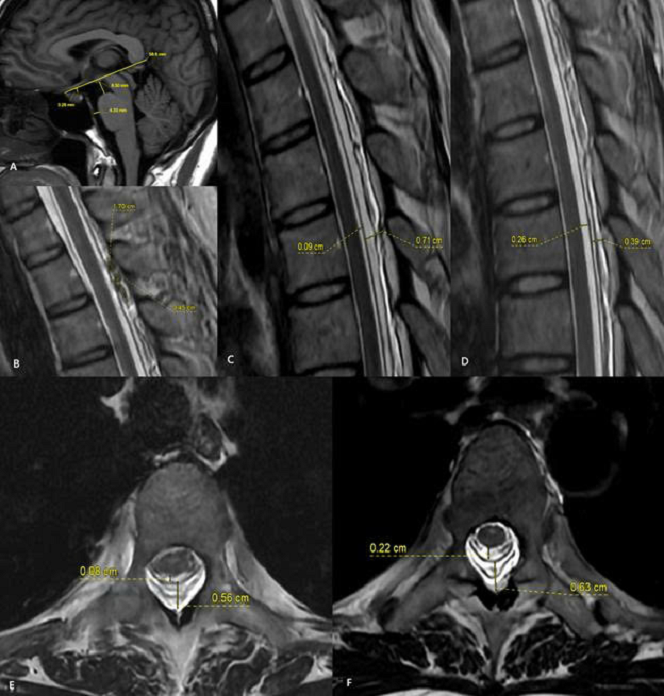Hình ảnh MRI trước và sau thủ thuật vá máu ngoài màng cứng (EBP). Sau điều trị, khoang chứa dịch não tủy quanh tủy sống được mở rộng trở lại, trong khi khoang ngoài màng cứng thu hẹp rõ rệt. Những thay đổi này cho thấy áp lực dịch não tủy đã được cải thiện sau thủ thuật.