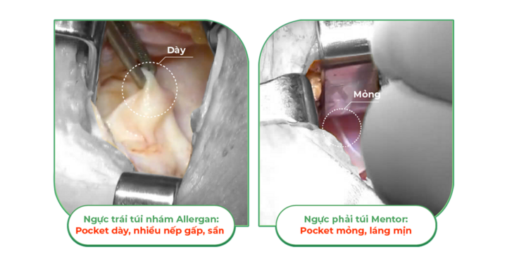 Khác nhau giữa túi ngực nhám và túi ngực trơn trên cùng 1 cơ thể - 3