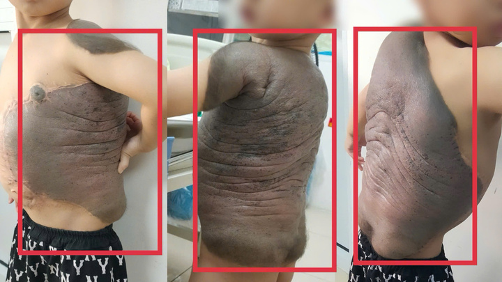 Ngay từ khi mới sinh, trên người bệnh nhi đã xuất hiện một khối nơ vi hắc tố rất lớn.