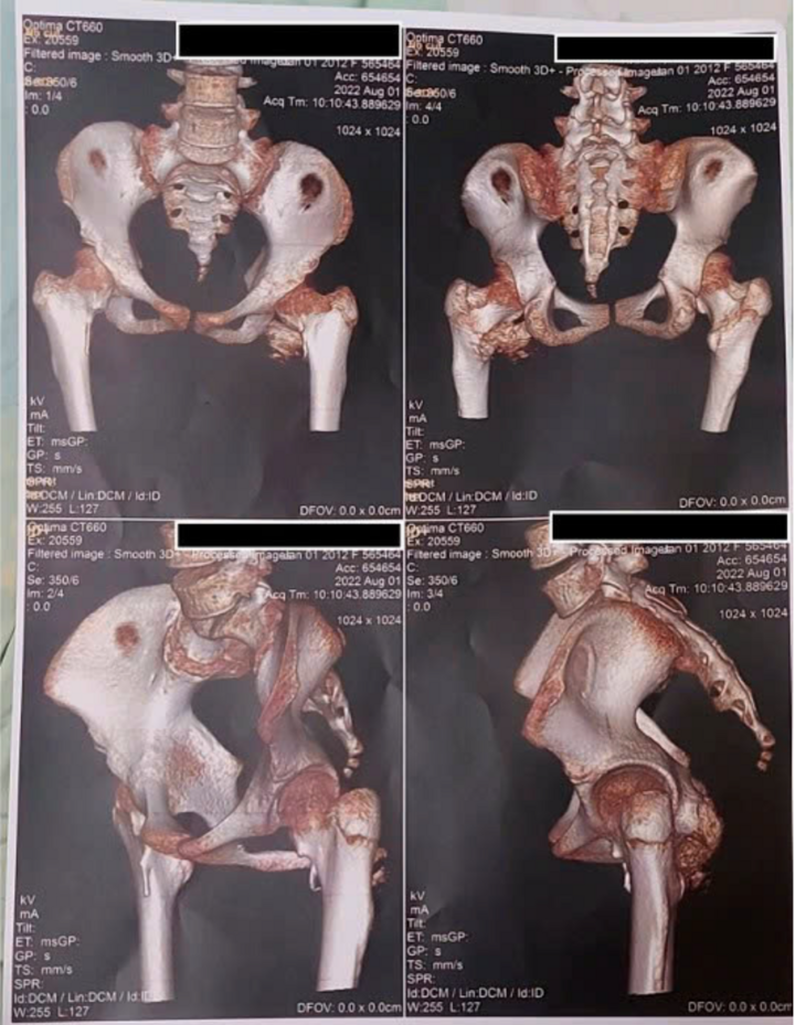 Các lát cắt hình ảnh dựng hình 3D từ chụp cắt lớp vi tính (CT) vùng khung chậu và khớp háng của bệnh nhân với hình ảnh canxi hóa mô mềm quanh khớp. (Ảnh: BVCC)