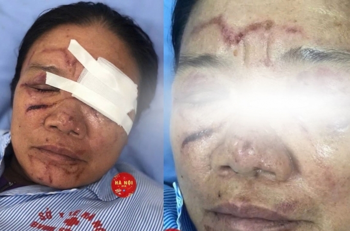 Sau khi được thăm khám và điều trị, sức khỏe bệnh nhân ổn định, hiện đang điều trị tại Bệnh viện Đa khoa Sóc Sơn.