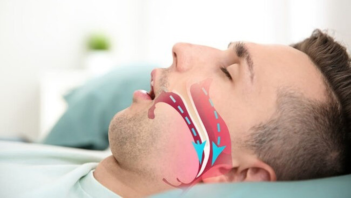 Tiếng ngáy kéo dài, ngắt quãng có thể cảnh báo ngưng thở khi ngủ, tăng nguy cơ đột quỵ, suy tim (Ảnh minh họa)