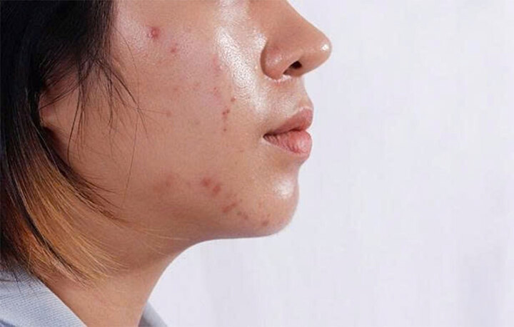 Việc chăm sóc sai cách có thể khiến tuyến bã nhờn hoạt động mạnh hơn.
