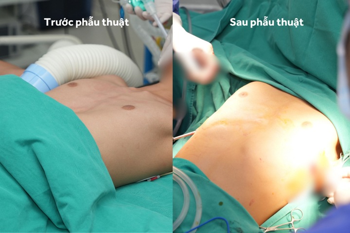 Hình ảnh so sánh lồng ngực của bệnh nhân trước và sau phẫu thuật.