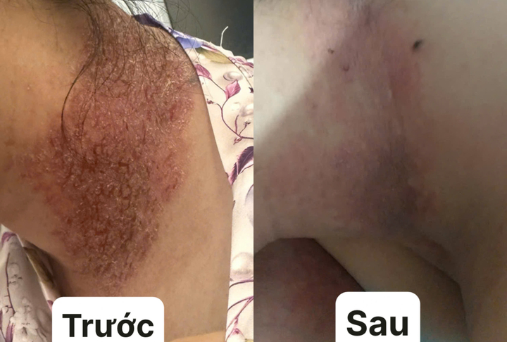 Các triệu chứng giảm rõ rệt sau khi điều trị (Ảnh: BVCC)