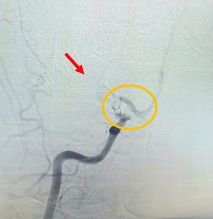 Hình ảnh MRI cho thấy người bệnh bị tắc động mạch cảnh trong bên phải đoạn C7. (Ảnh: BVCC)