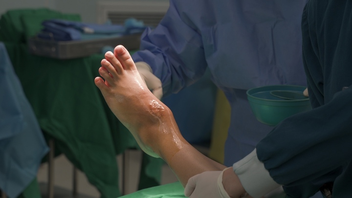 Khối u âm thầm phá huỷ đến 80% thể tích xương sên của người bệnh, gây ra những cơn đau đầy ám ảnh.