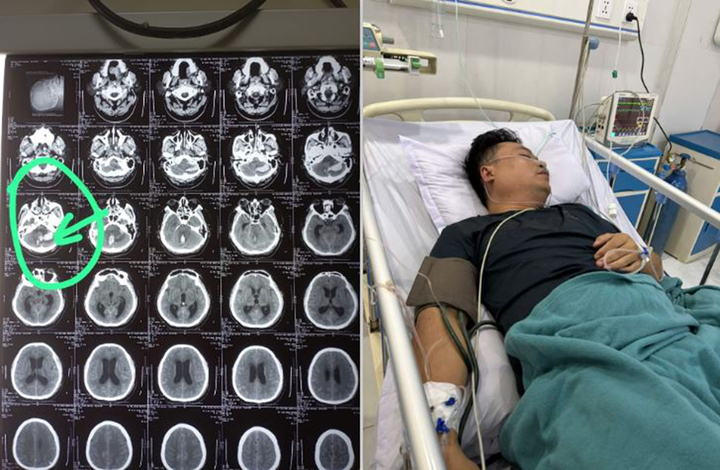 Anh Phương bất ngờ bị xuất huyết não (Ảnh: BVCC)