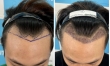 Cấy tóc tự thân tại Black Hair – giải pháp trị hói đầu hiệu quả