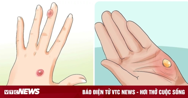 Cách chữa vết bỏng bị phồng rộp