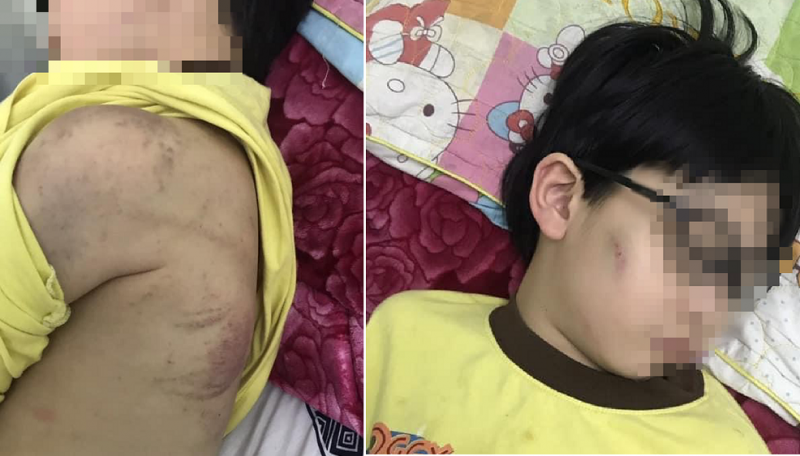 Cháu bé 8 tuổi ở Quảng Ninh bị mẹ bạo hành phải nhập viện - 1