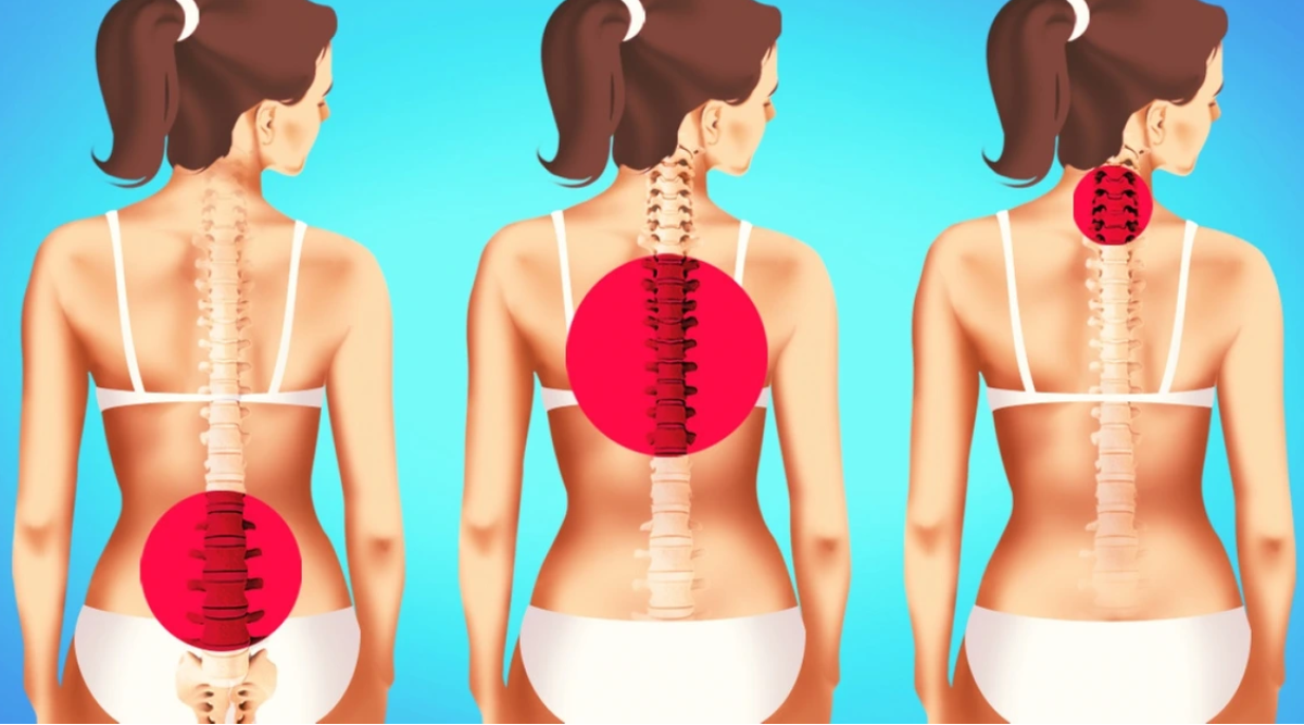 Bài tập thể dục hiệu quả cho người bị đau lưng, phòng ngừa bệnh về cột sống - 1