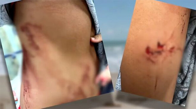 Bé gái 13 tuổi dũng cảm chiến đấu với cá mập dù bị cắn chảy máu - 1