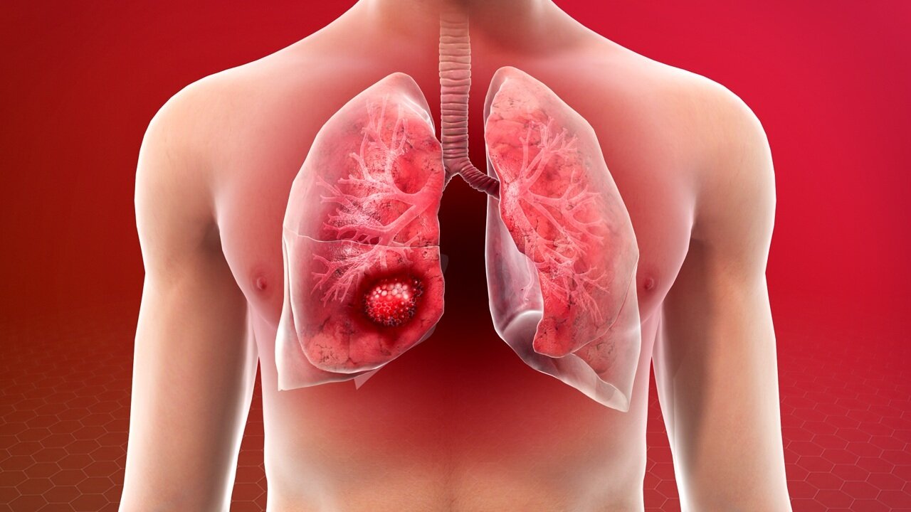 4 dấu hiệu của cơ thể cảnh báo ung thư phổi - 1