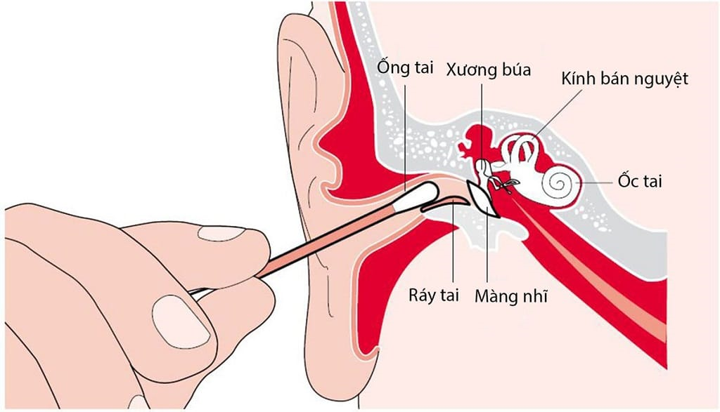 Hạn chế ngoáy tai, không nên quá 2 - 3 lần/ tuần.