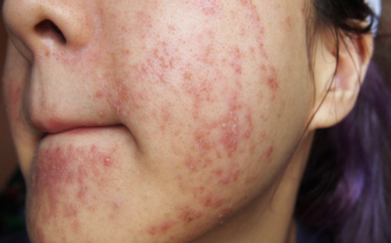 Sử dụng mỹ phẩm chứa chất cấm có thể gây tổn thương da.