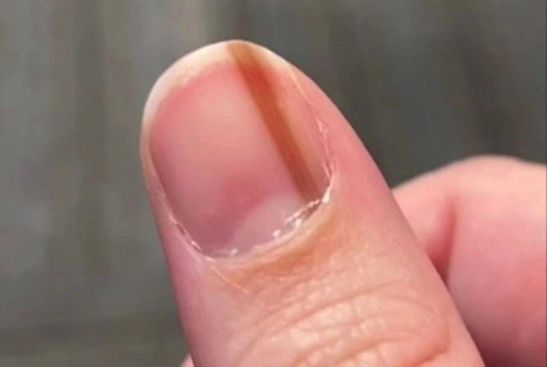 Nhiều người thắc mắc móng tay xuất hiện sọc đen có phải ung thư da.