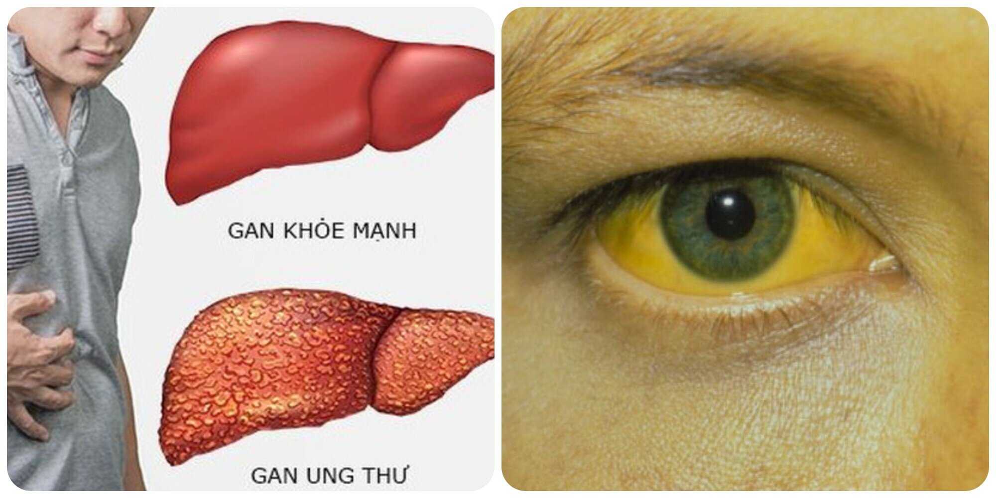 Vàng da vàng mắt cũng là một trong những dấu hiệu của bệnh ung thư.