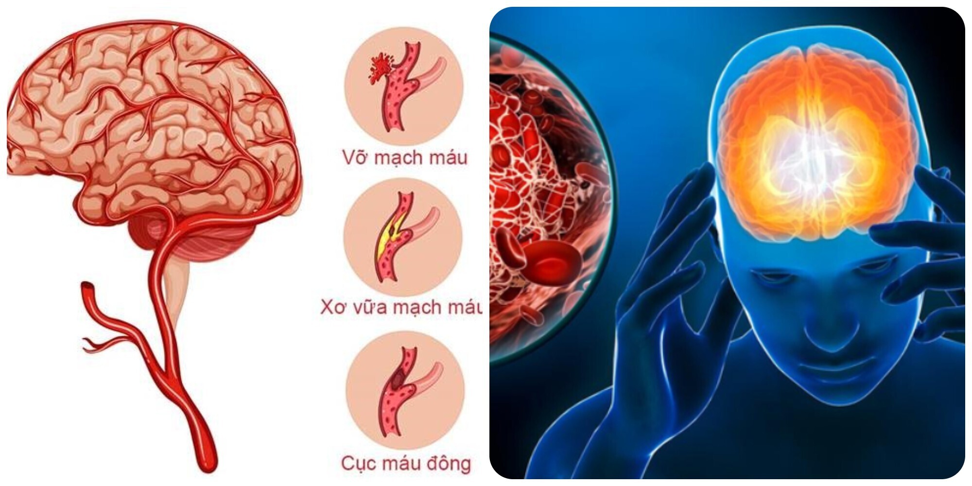 Đột quỵ có thể đe doạ tính mạng con người.