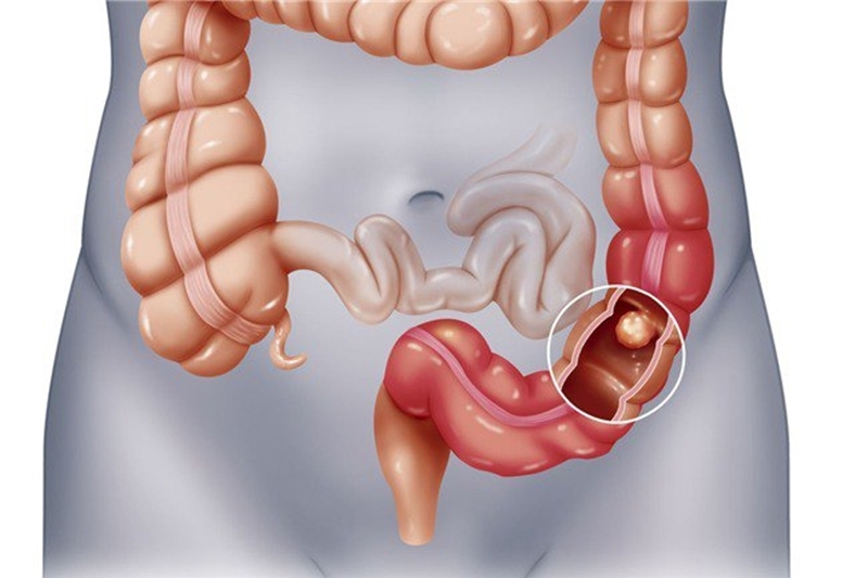 Ung thư đại tràng là loại ung thư khá phổ biến hiện nay. (Ảnh: Sohu)
