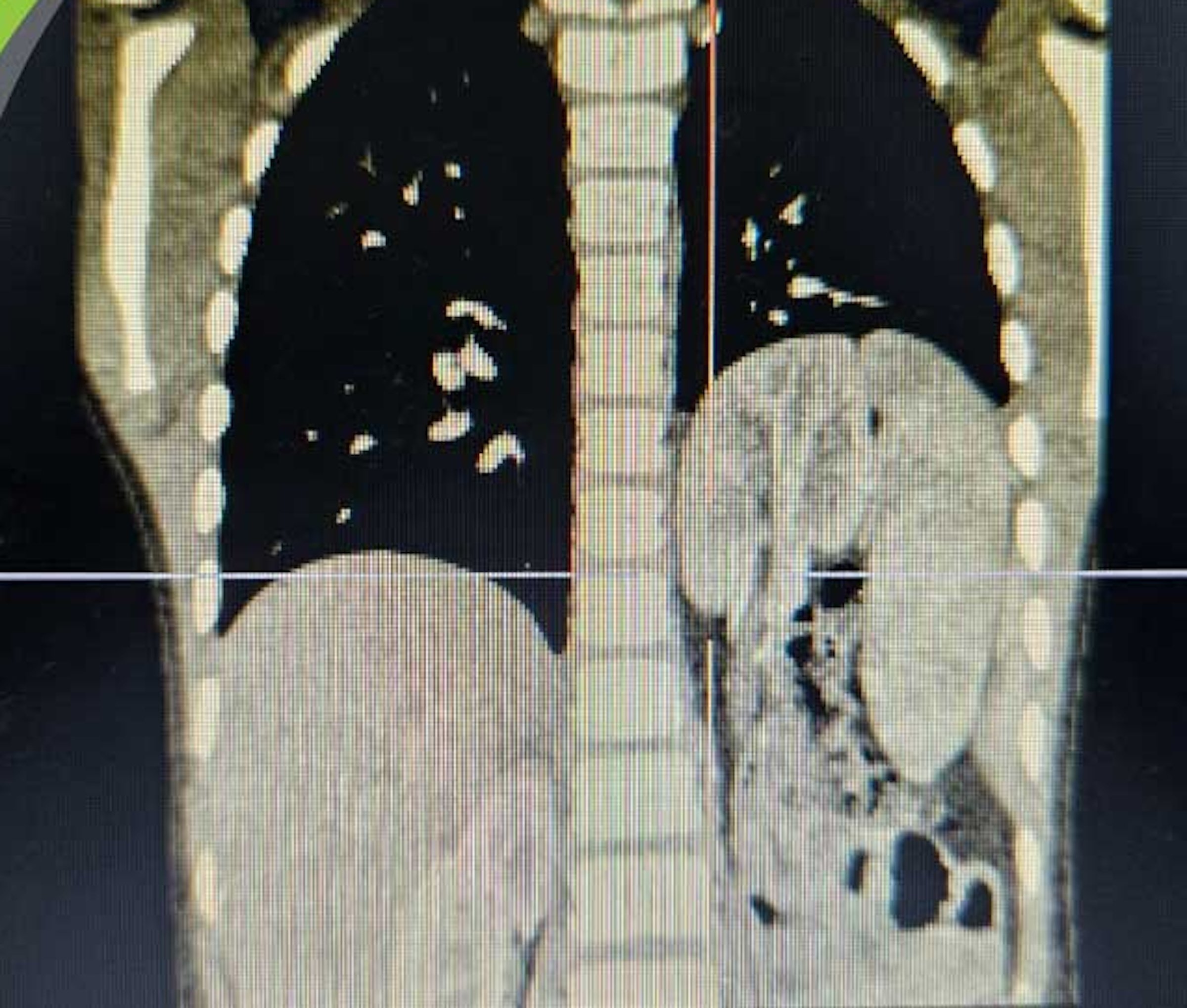 Hình ảnh chụp thoát vị hoành trái bẩm sinh với tạng thoát vị là lách, ruột non, đại tràng và kèm theo thận lạc chỗ trên lồng ngực của trẻ.