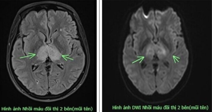 Hình ảnh nhồi máu đội thị 2 bên. (Ảnh: BVCC)