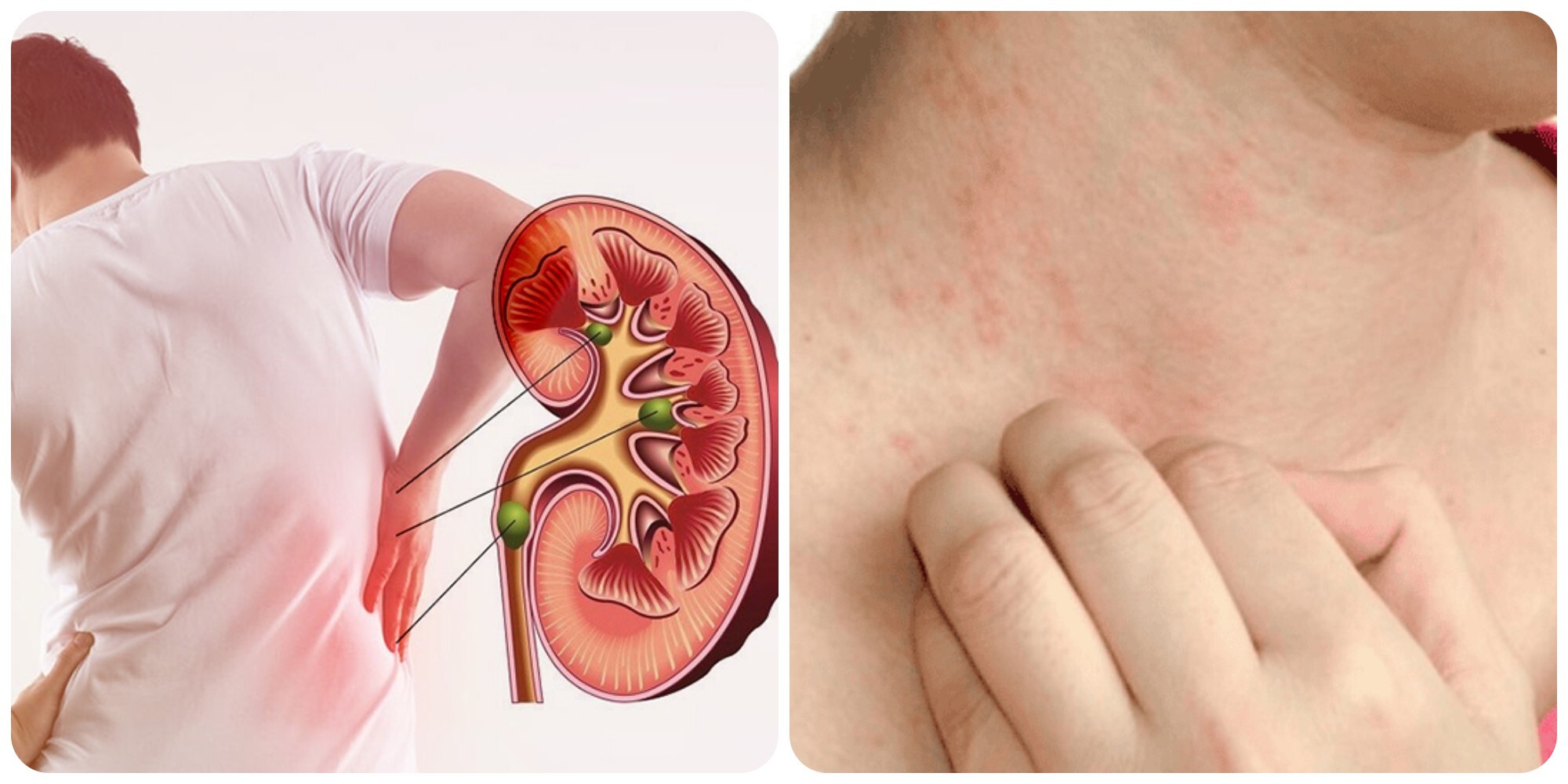 Đau lưng và phát ban là những dấu hiệu cảnh báo suy thận giai đoạn đầu
