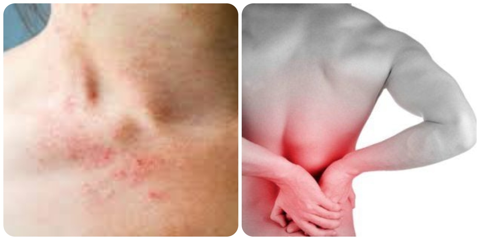 Da bị phát ban và đau lưng là những dấu hiệu cảnh báo suy thận nhẹ.