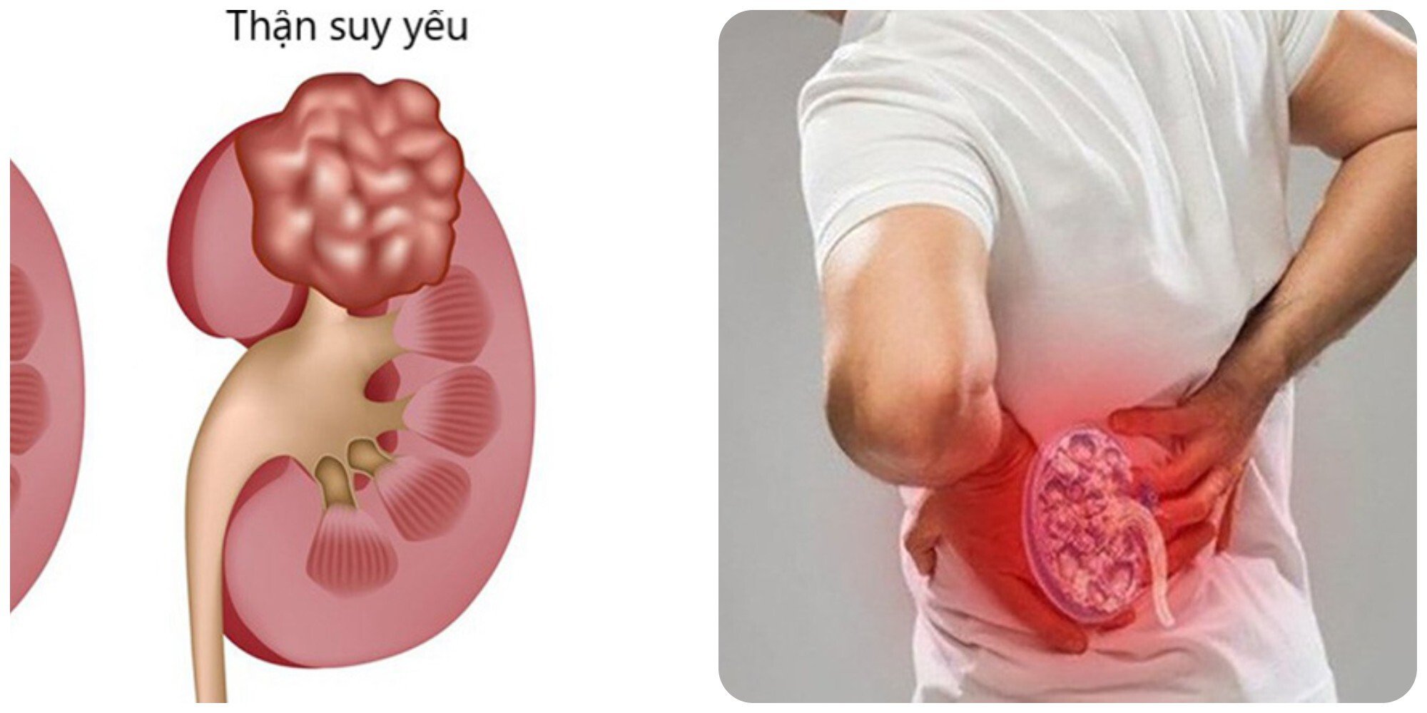 Đau thắt lưng là một trong những biểu hiện thận yếu