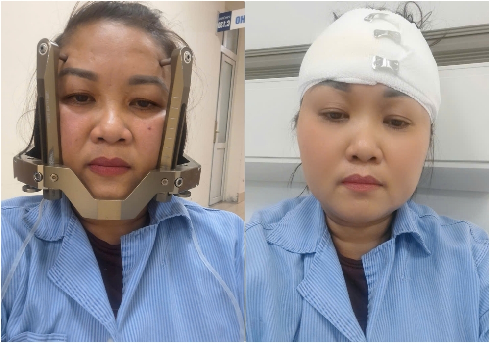 Bệnh ung thư của chị Thục bị di căn não, buộc phải xạ phẫu gamma knife.
